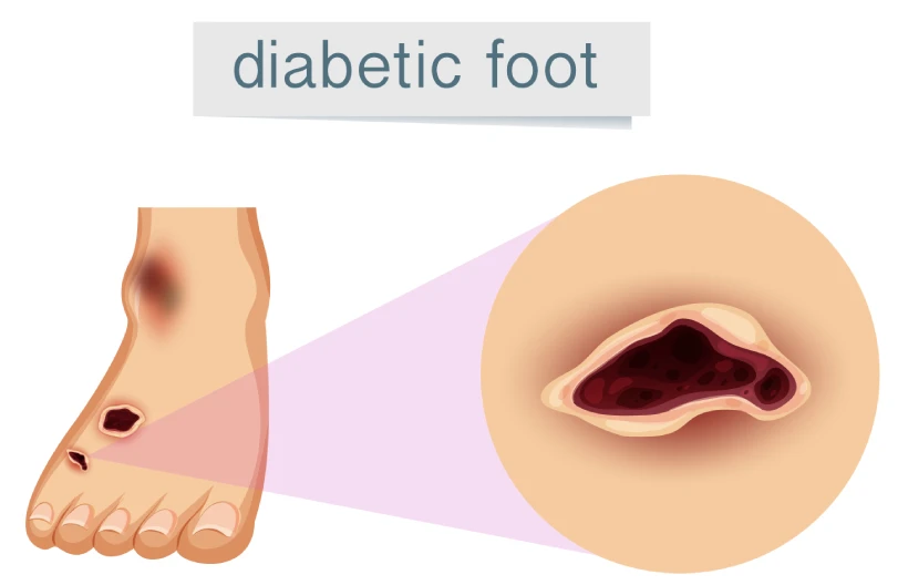 Diabetic foot surgeon in Ludhiana