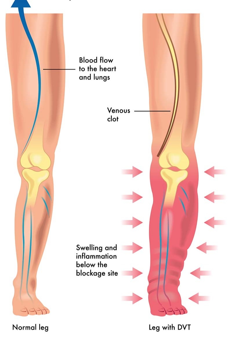DVT treatment in Ludhiana