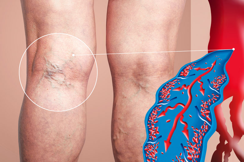 deep vein thrombosis specialists in Ludhiana