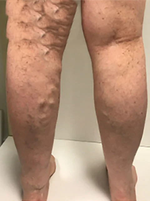 Varicose veins treatment