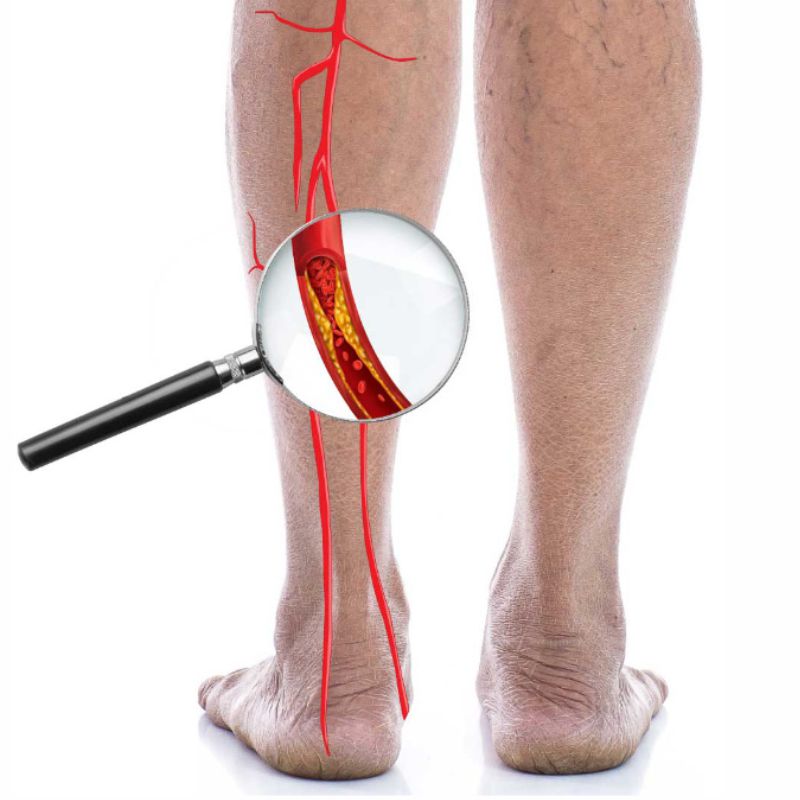 Varicose veins doctor in Punjab