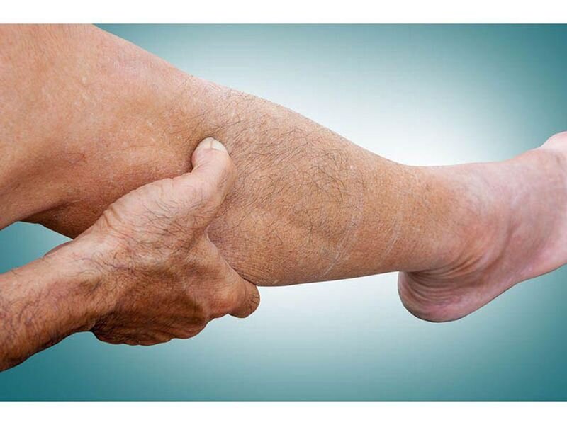 Varicose veins risk factors