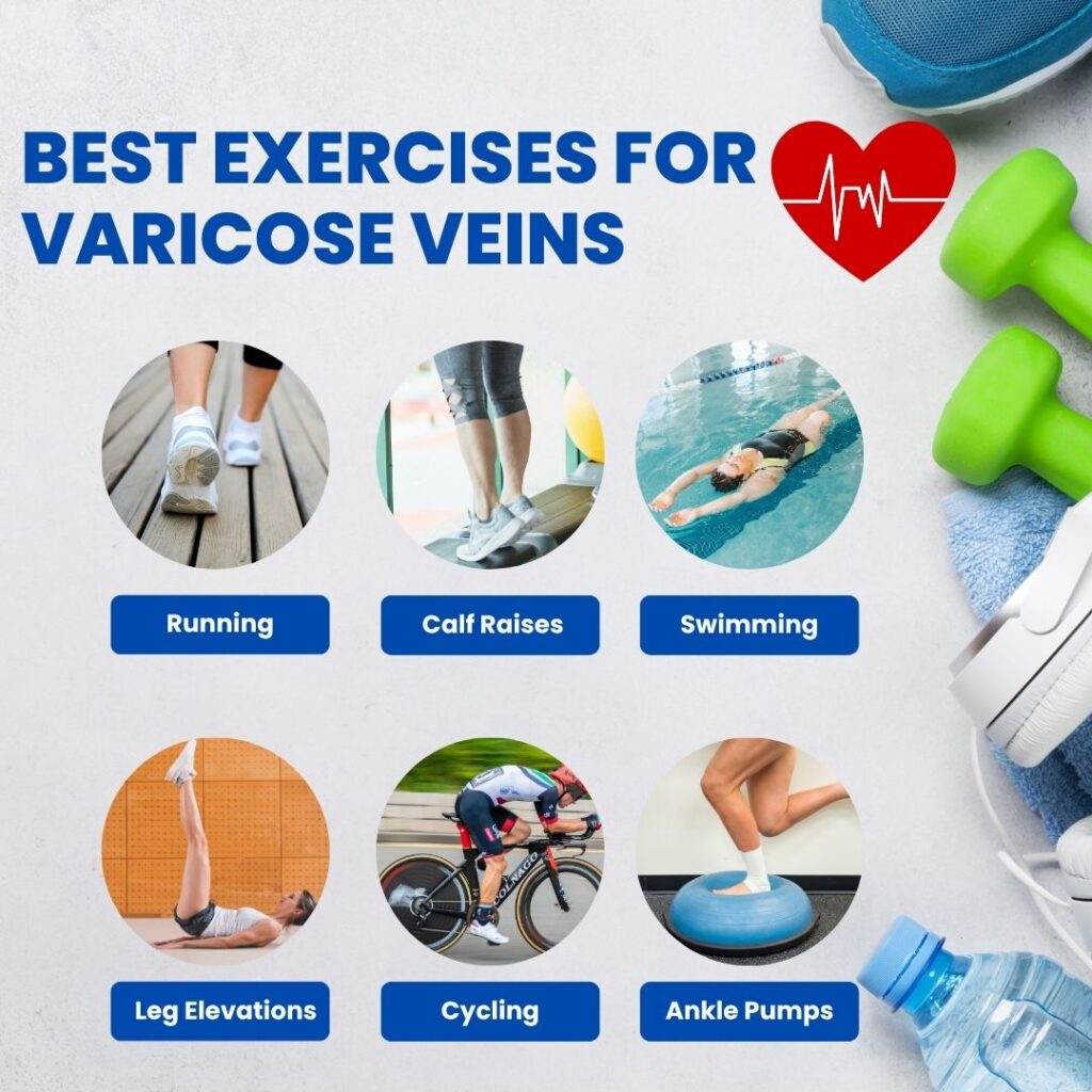 Best Exercises for Varicose Veins