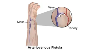 av fistula complications