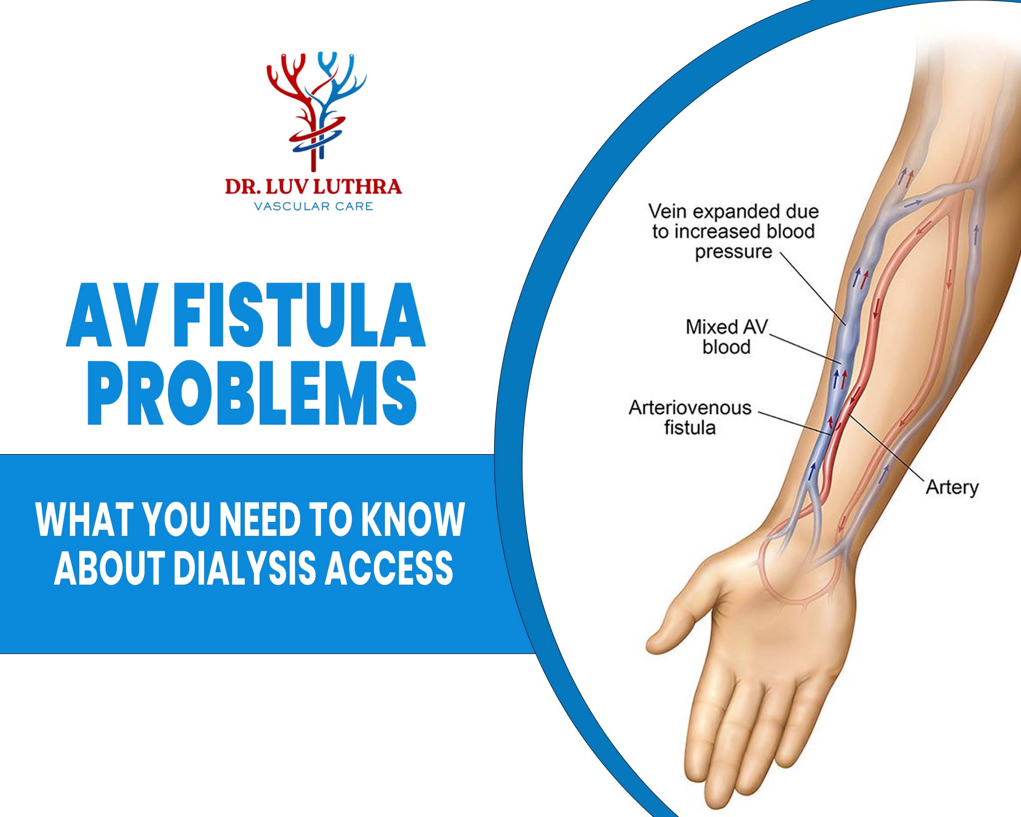 AV Fistula Problems: What You Need to Know About Dialysis Access