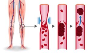 deep vein thrombosis (DVT)