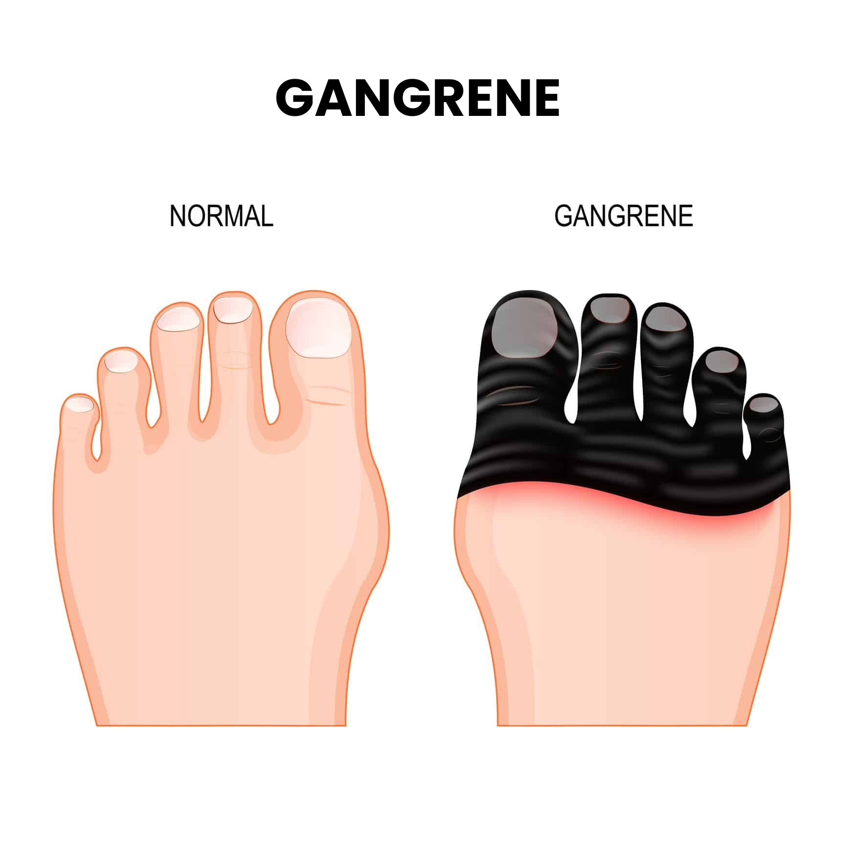 Gangrene