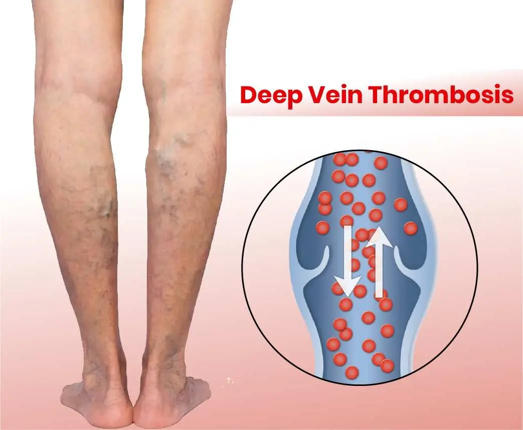 deep vein thrombosis (DVT)