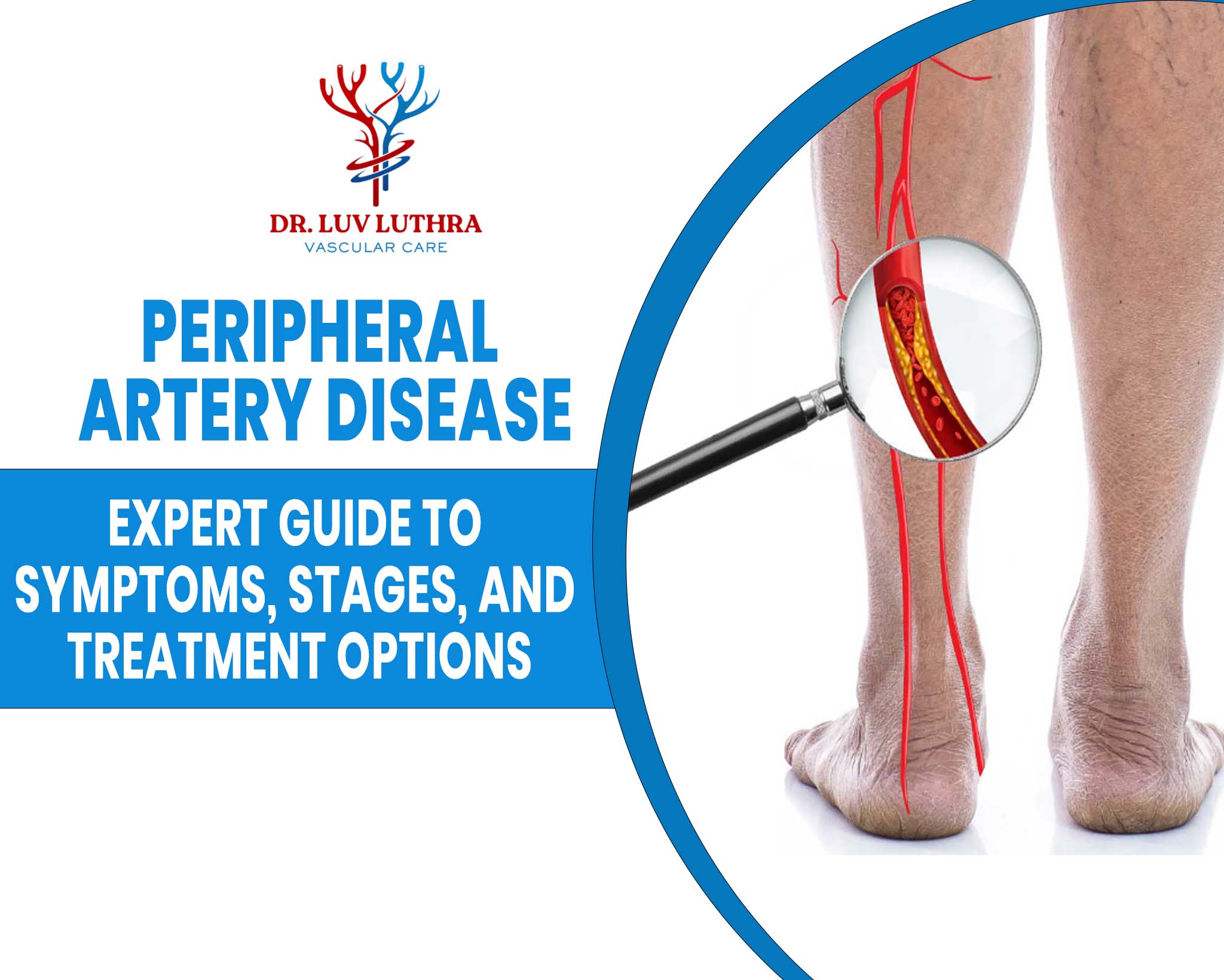 Peripheral Artery Disease (PAD): Expert Guide to Symptoms, Stages, and Treatment Options