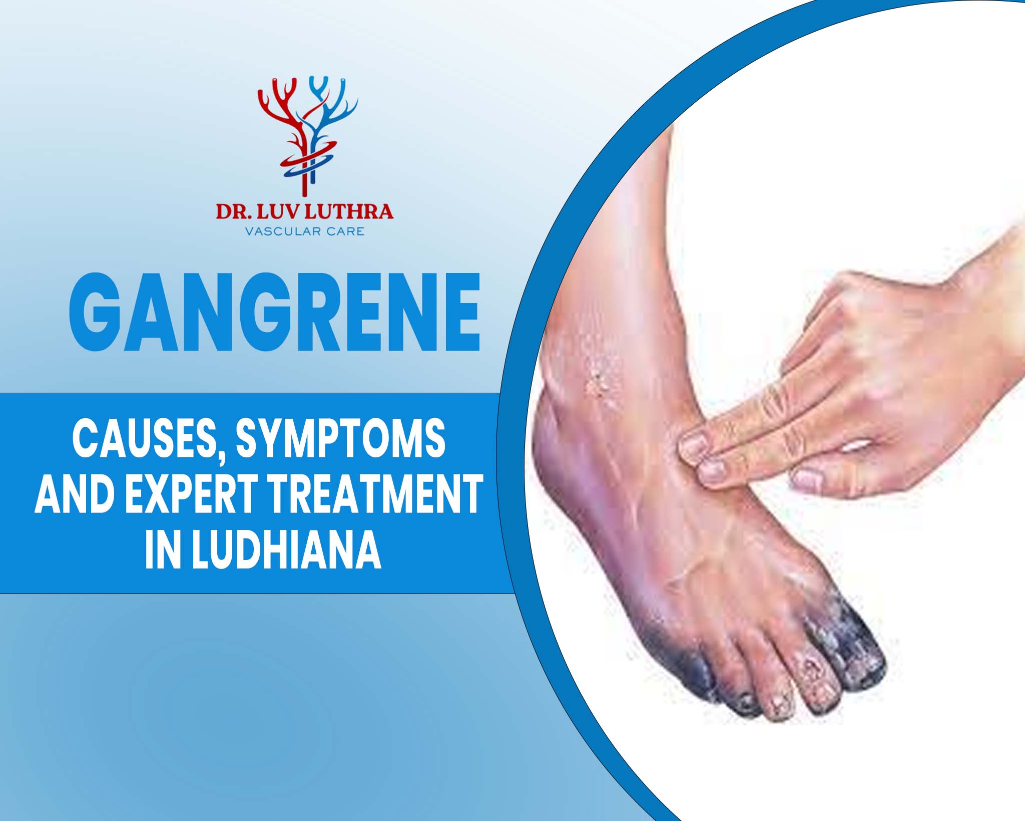 Gangrene: Causes, Symptoms, ICD-10 Codes, and Expert Treatment in Ludhiana