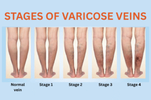 stages of varicose veins