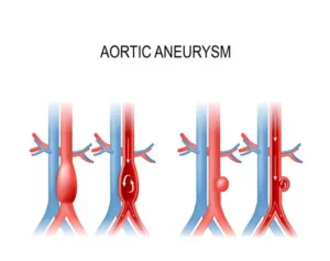 Aortic Aneurysm: Causes, Symptoms and Treatment guide