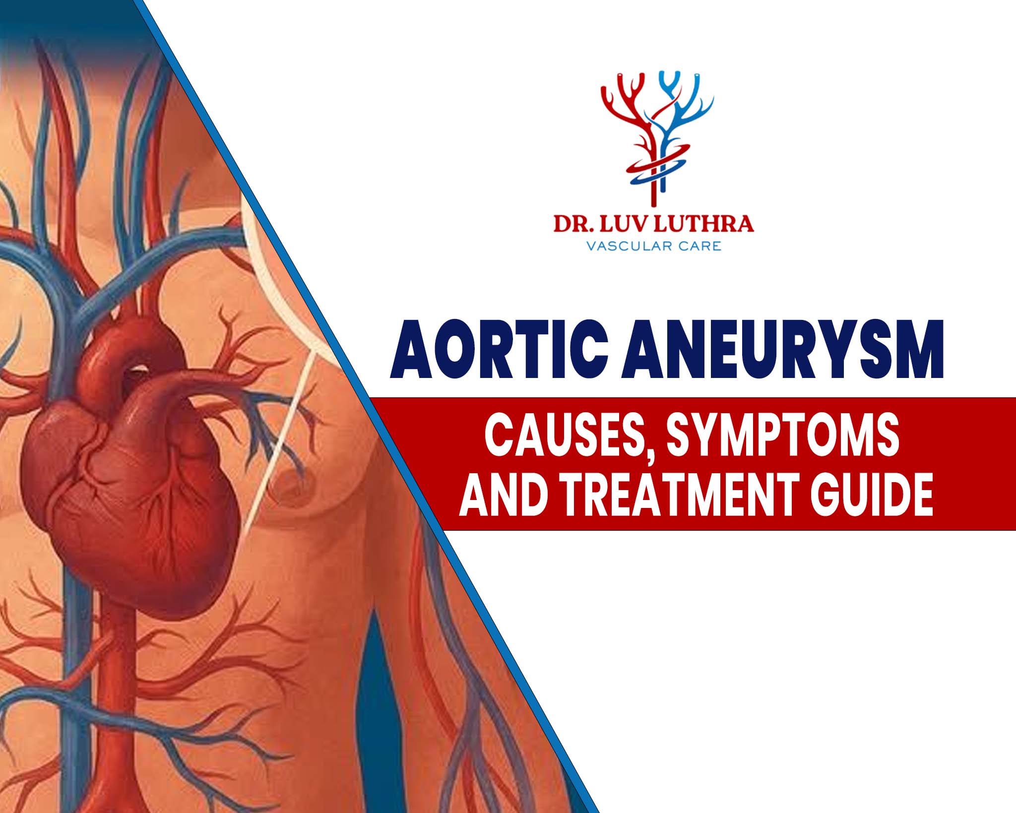 Aortic Aneurysm: Causes, Symptoms and Treatment Guide
