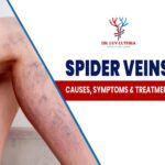 Spider Veins: Causes, Symptoms & Treatment | Dr Luv Luthra