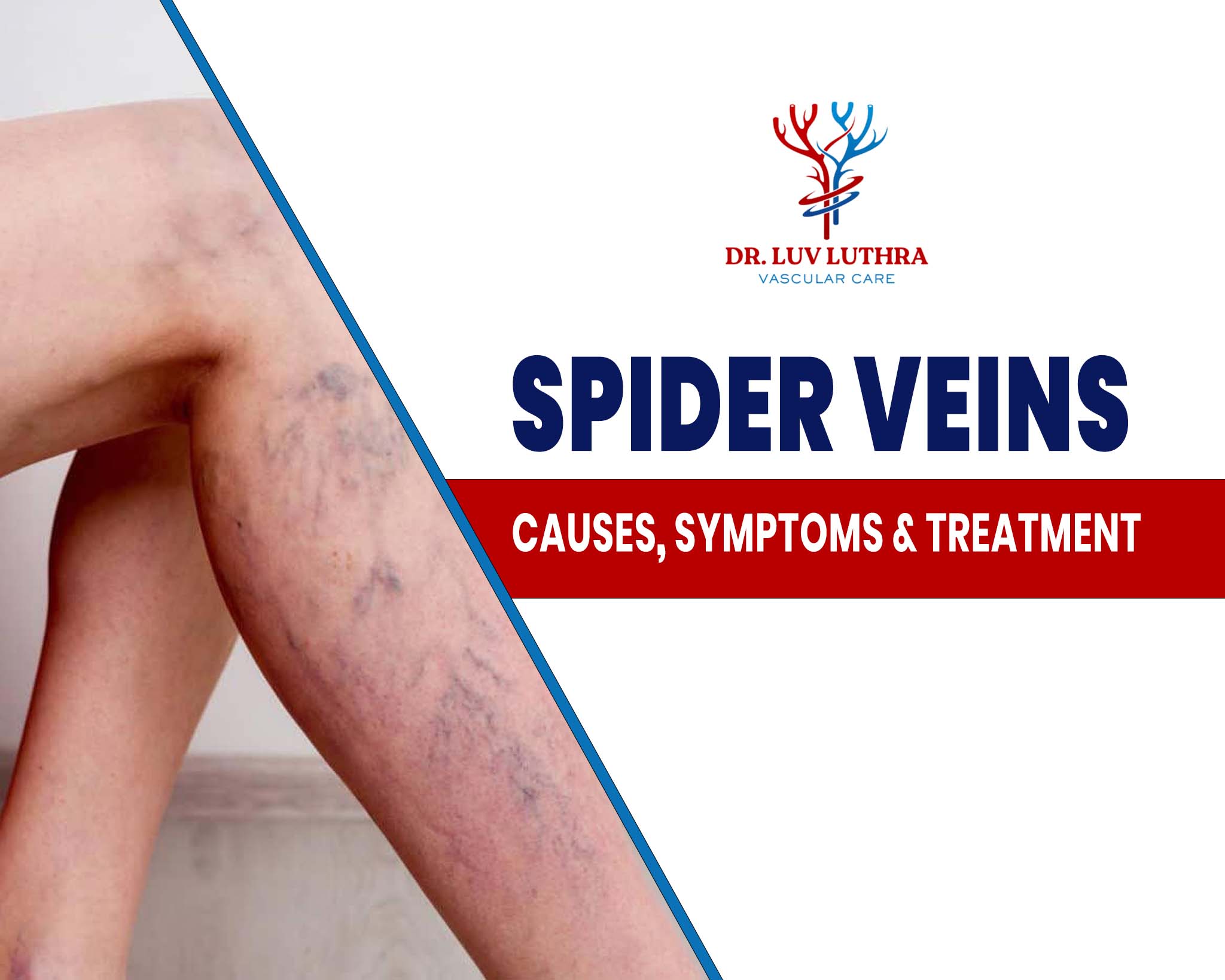 Spider Veins: Causes, Symptoms & Treatment | Dr Luv Luthra