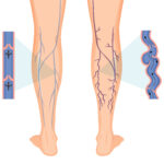 Varicose Vein Treatment