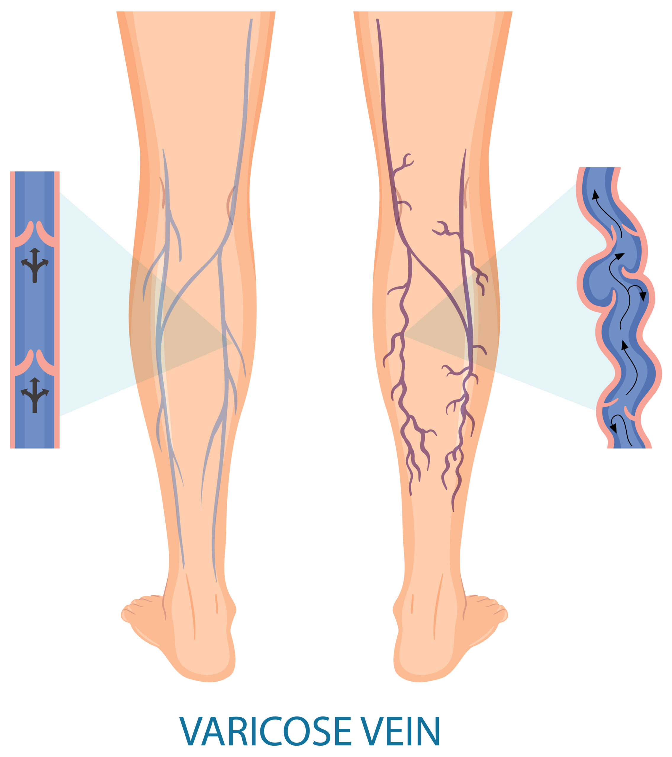 Varicose Vein Treatment