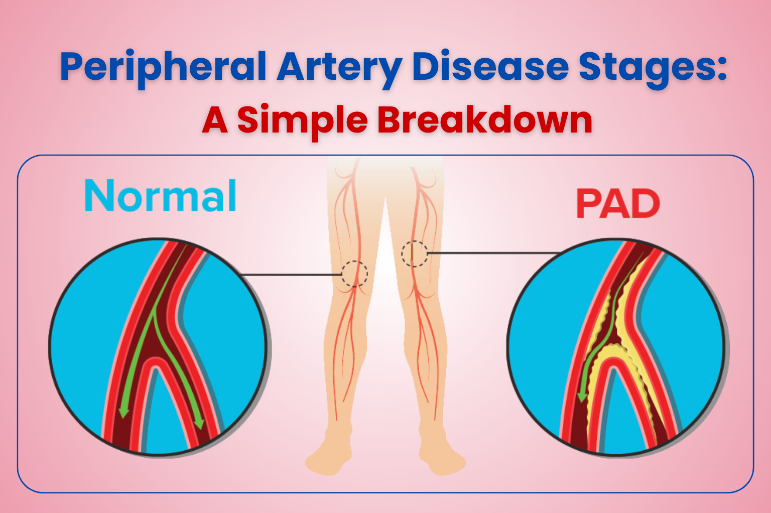 Peripheral Artery Disease treatment in Ludhiana by Dr Luv Luthra showing normal vs blocked arteries in legs
